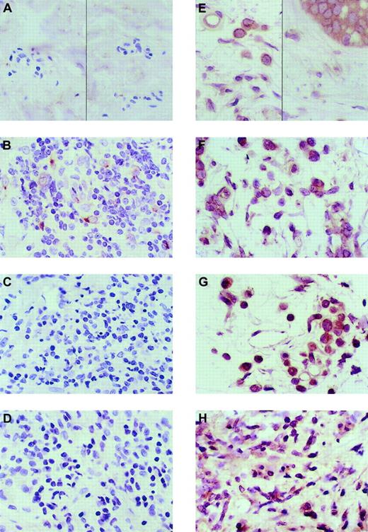 Fig. 1. Immunohistologic analysis of the expression of CCL19 and CCL20 in healthy and T-cell infiltrative skin diseases. / The antibody-specific peroxidase reaction is stained brown; the hematoxylin nuclear counterstain is blue. All photomicrographs are at × 50 original magnification. (A) CCL19 expression in healthy skin. (B) CCL19 in atopic dermatitis. (C) CCL19 in lichen planus. (D) CCL19 in GVHD. One of the 3 skin samples of atopic dermatitis had expression of CCL19 in dendritic cells, which is shown in panel B. (E) CCL20 expression in healthy skin keratinocytes (right) and macrophages (left). (F) CCL20 expression in atopic dermatitis, (G) CCL20 expression in lichen planus, and (H) CCL20 expression in GVHD. There was no distinction in CCL20 expression between healthy and diseased skin. Three separate patient samples were tested for healthy and 3 for diseased skin.