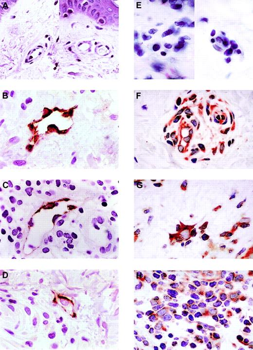 Fig. 2. Immunohistologic analysis of the expression of CCL21 and CCR7 in healthy skin and T-cell autoimmune skin disease. / CCL21 is not expressed in samples of healthy skin (A) but is expressed in venule endothelial cells of atopic dermatitis (B), lichen planus (C), and graft-versus-host disease by immunohistology (D). (E) CCR7 expression in healthy skin. (F) CCR7 expression in atopic dermatitis. (G) CCR7 expression in lichen planus. (H) CCR7 expression in GVHD. Three distinct patient skin samples were tested for each disease and 3 for healthy skin. All showed results identical to those shown here. Lower power views of the autoimmune samples found that all venule endothelial cells express CCL21. The photomicrographs shown here are representative of all samples. All slides were photographed at × 50 original magnification.