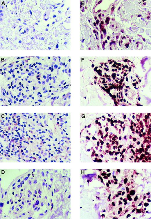Fig. 3. Immunohistologic analysis of the expression of CD45Ra and CD45Ro in healthy skin and autoimmune skin disease. / (A) CD45Ra is poorly expressed in cells of healthy skin. CD45Ra is also poorly expressed in rare lymphocytes in skin samples from patients with T-cell autoimmune diseases: atopic dermatitis (B), lichen planus (C), and graft-versus-host disease (D). However, most of the skin-infiltrating lymphocytes in both healthy and diseased skin are CD45Ra+. (E) CD45Ro is significantly expressed in samples of healthy skin. Also, CD45Ro is highly expressed in skin samples from patients with T-cell autoimmune diseases: atopic dermatitis (F), lichen planus (G), and GVHD (H). The same 3 distinct patient skin samples were tested for each disease, and the same 3 for healthy skin as in the other figures. There was no difference between the samples displayed here and those not shown. All slides were photographed at × 50 original magnification.