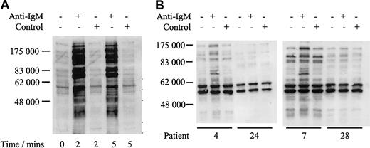Fig. 2. Analysis of tyrosine phosphorylated proteins in Daudi cells and CLL samples. / Immunoblot analysis of tyrosine phosphorylated proteins in Daudi cells (A) or representative CLL samples (B) incubated with anti–human IgM or isotype control antibody. Tyrosine phosphorylated proteins were detected by direct immunoblotting using antibody 4G10. Proteins were separated on a 10% SDS-PAGE gel. The molecular mass of protein standards is shown. Data for all CLL samples are summarized in Table2.