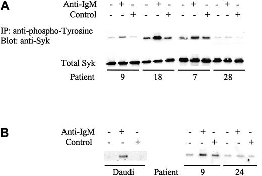 Fig. 4. Analysis of Syk phosphorylation following anti-IgM treatment. / (A) CLL samples were incubated with anti-IgM or control antibody for 2 minutes. Tyrosine-phosphorylated Syk was analyzed by immunoprecipitation (IP) with phosphotyrosine-specific antibody followed by blotting with the Syk-specific antibody (top panel). Total Syk expression was analyzed by direct immunoblotting (bottom panel). Representative results are shown. Table 2 provides summary of data for all samples. (B) Daudi cells or CLL samples were incubated with anti-IgM or control antibody for 2 minutes. Tyrosine phosphorylation on Tyr525/526 of Syk was detected by immunoprecipitation using the Syk phospho-Tyr525/526–specific antibody followed by direct immunoblotting for Syk. Representative results are shown for analysis of 6 CLL samples. Patient 9 is an unmutated sample that showed global tyrosine phosphorylation following anti-IgM treatment, whereas patient 24 is a mutated sample that did not show phosphorylation with anti-IgM.