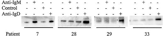 Fig. 5. Analysis of Syk phosphorylation following anti-IgD treatment. / CLL samples were incubated with anti-IgM, anti-IgD, or control antibody for 2 minutes. Tyrosine-phosphorylated Syk was analyzed by immunoprecipitation with phosphotyrosine-specific antibody followed by blotting with the Syk-specific antibody. Representative results are shown.