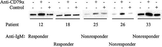 Fig. 6. Analysis of Syk phosphorylation following anti-CD79α treatment. / CLL samples were incubated with anti-CD79α or control antibody for 2 minutes. Tyrosine-phosphorylated Syk was analyzed by immunoprecipitation with phosphotyrosine-specific antibody followed by blotting with the Syk-specific antibody. Representative results are shown.