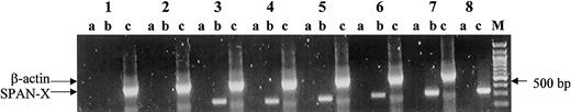 Fig. 1. RT-PCR analysis of the SPAN-Xb gene in patients with hematologic malignancy using a pair of sequence-specific primers. / SPAN-Xb mRNA could be detected only in patients with hematologic malignancy and not in the peripheral blood or bone marrow of healthy donors. Lane 1, peripheral blood from a healthy donor; lane 2, bone marrow from a healthy donor; lanes 3-6, tumor cells from patients with AML (lane 3), CLL (lane 4), CML (lane 5), and MM (lane 6); lane 7, normal testis RNA; lane 8, positive control amplification using a plasmid containing SPAN-Xb cDNA. M indicates molecular marker; lane a, PCR of DNase I-treated RNA (ie, PCR without RT); lane b, PCR of RNA that underwent RT; and lane c, control amplification for β-actin gene fragment.