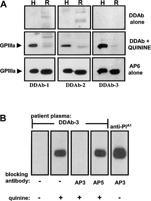 Fig. 1. DDAbs reacted in Western blots with human, but not rat, GPIIIa, and were blocked by monoclonal AP3. / (A) The 3 DDAbs recognized human (H), but not rat (R), GPIIIa in the presence, but not in the absence, of quinine. Monoclonal AP6 reacted with GPIIIa from both species regardless of whether the drug was present. (B) The drug-dependent reaction of DDAb 3 with human GPIIIa (lane 2) was blocked by monoclonal AP3 (lane 3), but not by AP5 (lane 4). Reactions of an alloantibody specific for PlA1 (HPA-1a) were unaffected by AP3 (lane 5). Essentially identical reactions were obtained with DDAbs 1 and 2 (not shown).