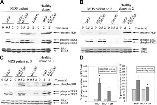 Fig. 9. Phosphorylation of PKB/AKT and ERK1/2 in response to fMLP and GM-CSF is decreased in MDS patients. / Neutrophils were isolated from whole blood from MDS patients and healthy controls as described. Cells were stimulated with 1 μM fMLP with or without priming with 5 ng/mL GM-CSF or with 5 ng/mL GM-CSF alone for the indicated time. Stimulation of the neutrophils was stopped by the boiling of samples in 1 × Laemmli buffer. Proteins were separated by SDS-PAGE, and PKB/Akt activation was detected by Western blotting, using antibodies against phosphorylated PKB/Akt (A-C, upper panels). The same blots were reprobed with an antibody against phosphorylated ERK1/2 (A-C, middle panels). ERK1/2 is shown in the lower panels and represents equal protein loading. The experiment was performed for 5 MDS patients and healthy controls. One patient was tested twice independently, with identical results. Results of 3 representative experiments are shown (A-C). (D) Phosphorylation of PKB/Akt and ERK1/2 was quantified by densitometry of the films. Level of phosphorylation of PKB/Akt and ERK1/2 in neutrophil lysates from healthy donors was expressed as a percentage of the phosphorylation observed in cell lysates from MDS patients, run on the same gel. Significant differences are indicated with asterisks (P < .05).