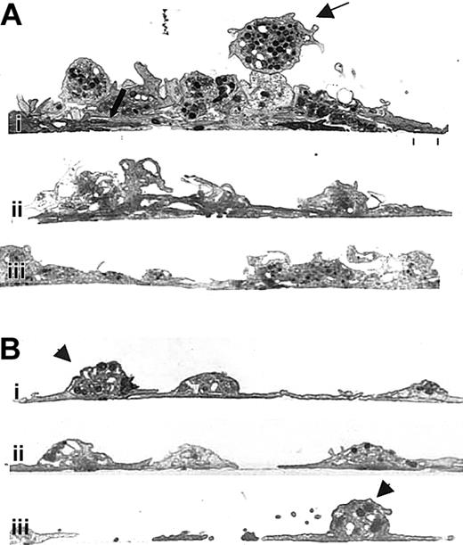 Fig. 5. Unlike normal platelets, platelets treated with antibody 7E3 do not form multiple layers on a collagen-coated surface. / Human platelets were prepared and added to collagen-coated microtiter wells as in Figure 3. The specimens were then prepared for transmission electron microscopy after spreading for 1 hour at 22°C. (A) Three images from different regions (Ai, Aii, and Aiii) containing untreated human platelets showing an initial layer of spread platelets (lower thick arrow) and multiple additional layers of platelets with variably intact granulomeres and closely apposed membranes. The thin upper arrow points to a platelet that is tethered to the spread platelets below but retains an intact granulomere. (B) Three images from different regions containing 7E3-treated platelets (Bi, Bii, and Biii), which demonstrate primarily a single layer of platelets. Where one platelet partially spreads over another, the borders of the platelets remain distinct. Granulomeres of the 7E3-treated platelets making up the initial layer (Bi, Biii, arrowheads) are more distinct than those making up the initial layer of the untreated platelets shown in panel A.