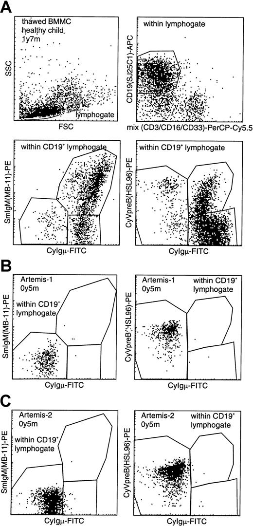 Fig. 4. Flow cytometric analysis of CD19+lymphocytes in BM from a healthy control and 2 RS-SCID patients withArtemis gene mutations. / (A) Gating on CD19+ lymphocytes with exclusion of CD3+ T lymphocytes, CD16+ NK cells, and CD33+ myeloid cells, resulting in a purified “B-cell gate” (upper panels). Within this B-cell gate, expression of cytoplasmic VpreB (CyVpreB), cytoplasmic Igμ (CyIgμ), and surface membrane IgM (SmIgM) can be evaluated (lower panels), showing several subsets in normal BM with most cells in the most mature (Igμ+) precursor B-cell stages. (B-C) Patients Artemis-1 and -2 showed a complete arrest at the transition from CyIgμ− pre-B-I cells to CyIgμ+ pre-B-II cells. Although no CyIgμ expression was detected, virtually all CD19+ precursor B cells were positive for CyVpreB. This is fully in line with the expression of CyVpreB in early precursor B cells.