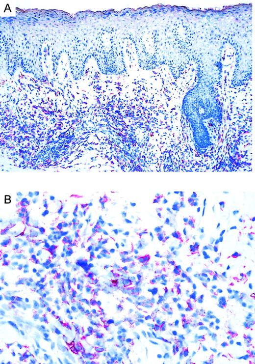 Fig. 1. Immunoreactivity of CCR3 in CTCL. / (A) CCR3 immunoreactivity in cryosections of a CD30+large-cell CTCL (no. 7) with the use of the alkaline phosphatase/anti–alkaline phosphatase method. Original magnification, × 100. (B) CCR3 immunoreactivity in cryosection of a CD30+ large-cell CTCL (no. 7) with the use of the alkaline phosphatase/anti–alkaline phosphatase method. Original magnification, × 400.