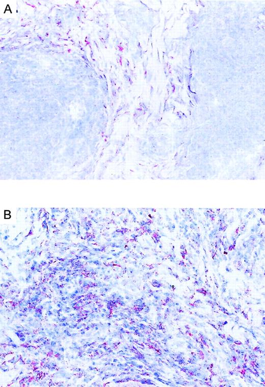 Fig. 4. Immunoreactivity of eotaxin in CTCL. / (A) Eotaxin/CCL11 immunoreactivity in cryosection of CD30−CTCL with the use of the alkaline phosphatase/anti–alkaline phosphatase method. Eotaxin/CCL11 is present only in connective tissue cells; tumor cell staining is negative. Original magnification, × 400. (B) Eotaxin/CCL11 immunoreactivity in cryostat section of CD30+ large-cell CTCL with the use of the alkaline phosphatase/anti–alkaline phosphatase method. Eotaxin/CCL11 is present in connective tissue cells and tumor cells, which were CD30+ in serial sections (data not shown). Original magnification, × 400.