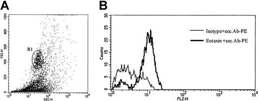 Fig. 5. Intracellular eotaxin expression in tumor cell suspensions. / (A) Analysis gated on high forward- and side-scatter cell population (R1), which corresponds to CD30+ tumor cells (patient no. 8). Data shown are representative of 3 experiments. (B) Intracellular flow cytometric staining of tumor cell suspensions for CCR3 ligand eotaxin/CCL11, after stimulation for 4 hours with phorbol myristate acetate (PMA) and ionomycin demonstrates expression of eotaxin in tumor cells