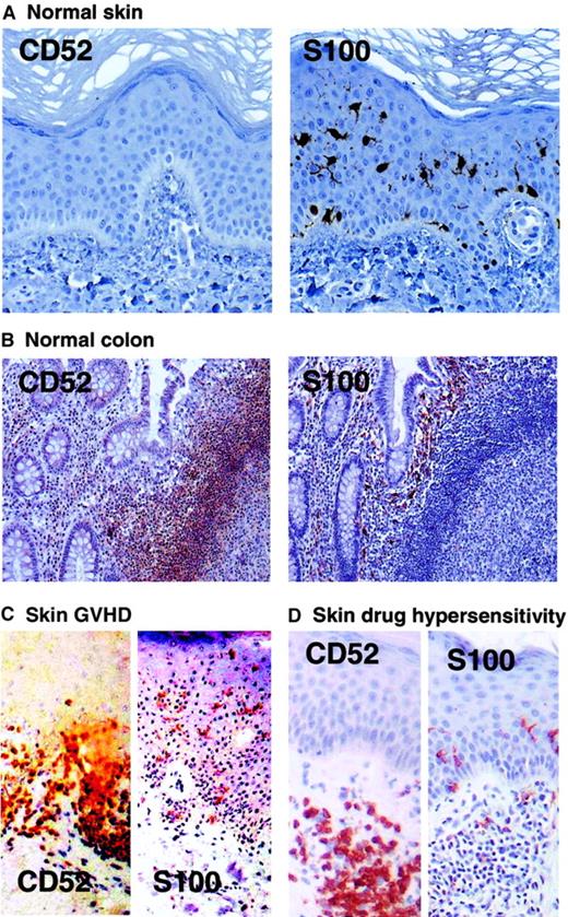 Fig. 6. Cutaneous or mucosal DCs do not express CD52 in vivo. / (A) Normal skin. Intraepidermal DCs (LCs) are immunopositive for S-100 protein but negative for CD52. Apart from dermal inflammatory CD52+ T-cell aggregates that could be seen as an artifact of the punch biopsy in some sections (not shown), no CD52+dendritic profiles were seen in the dermis. Factor XIIIa staining confirmed the presence of dermal DCs (not shown). (B) Normal colon. CD52+ T lymphocytes surround a lymphoid follicle in a colonic biopsy. Mucosal DCs, which are immunopositive for S-100 protein, are negative for CD52. Germinal center B cells stained in this paraffin-embedded and -fixed tissue were also negative as expected. (C) GVHD affecting the skin. Intraepidermal and dermal DCs are immunopositive for S-100 protein, but negative for CD52. Inflammatory T lymphocytes that are destroying the dermal-epidermal interface as part of the graft-host reaction are CD52+, but there are no CD52+ dendritic profiles. (D) Drug hypersensitivity reaction in the skin. CD52+ lymphocytes are seen in the superficial dermis. S-100 protein–positive DCs are present in the epidermis and superficial dermis but are consistently negative for CD52. Staining was performed as described in “Immunohistochemistry.” Original magnification × 100.