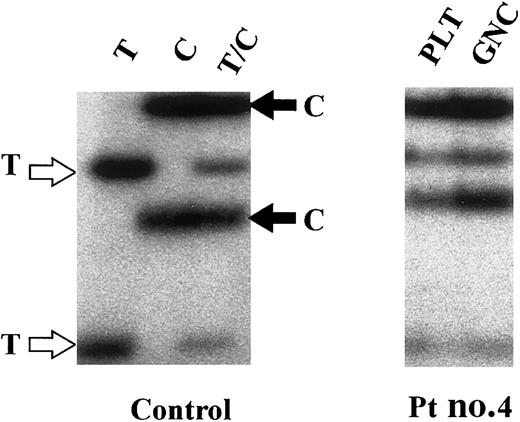 Fig. 4. Clonality assay of patient 4. / Clonality assay using glucose-6-phosphate dehydrogenase (G6PD) polymorphism (1311C>T). Control: Granulocyte RNA from a homozygous T (T), a homozygous C (C), and a heterozygous T/C (T/C) healthy control were used as a source of cDNA used for SSCP analyses. Patient 4: Expression of both C and T alleles was observed in platelet (PLT) and granulocyte RNA (GNC), indicative of a polyclonal hematopoiesis. Similar results were obtained in patients 1, 6, and 7 (data not shown).