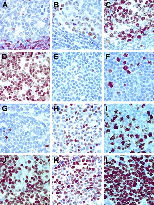 Fig. 3. Different patterns of expression of Ki67, p27KIP1, and BCL6 in lymphomas. / (A) p27KIP1 staining in nontumoral lymphoid tissue (a reactive tonsil). (B) BCL6 and (C) Ki67 in the same sample. (D) A B-CLL case with a high level of p27KIP1 expression. (E) Absence of BCL6 in the same sample and Ki67 (F), in this case, indicating the low-growth fraction of this tumor. (G) A DLBCL case showing absence of p27KIP1 in tumoral cells, with high levels of BCL6 (H) and Ki67 (I) expression. (J) An aggressive DLBCL case showing p27KIP1 overexpression associated with high levels of BCL6 (K) and Ki67 (L). Original magnifications, × 400.