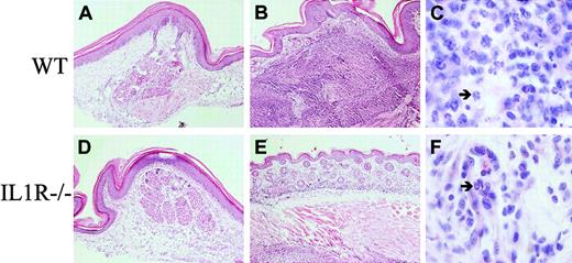 Fig. 7. Neutrophilic infiltration at the footpad injection site of CD95L-DC injection is IL-1 dependent. / C57BL/6 WT (A-C) and IL-1 R−/− (D-F) mice were injected subcutaneously with 3 × 105 bm12-lpr control (A, D) or CD95L-DCs (B-F). Footpad skin sections were realized 5 days later and stained with hematoxylin and eosin. Panels A and D show the histology of a conserved skin structure with negligible cell infiltration (original magnification × 100); panel B, an altered skin structure with dermis thickening and strong inflammation extended until the muscle cells layer (original magnification × 100); and panel C, a massive neutrophil recruitment (arrow) into the dermis (original magnification × 1000). Panel E shows a conserved skin histology with much less inflammatory cells (original magnification × 100), and panel F, mononuclear cells plus eosinophils (arrow) infiltrate located only into the dermis (original magnification × 1000). Representative sections from 3 to 6 individual mice were selected.