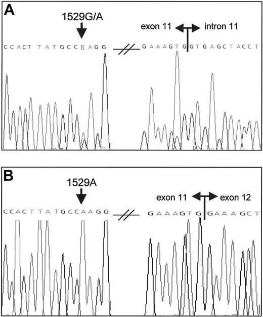 Fig. 2. Heterozygous PKLR c.1529G>A missense mutation and sole expression of the 1529A allele in the patient. / (A) PKLR DNA sequence analysis of exon 11 in the patient shows a heterozygous G>A substitution (arrow). The splice donor site of intron 11 is indicated. (B) RT-PCR analysis of the patient's RNA yielded only one transcript that contained the 1529A mutation (arrow), thereby indicating a severely reduced transcription of the in trans 1529G allele. Double horizontal arrows denote boundaries between exons.