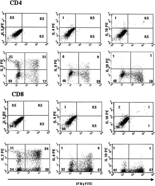 Fig. 2. Activation, transduction, and selection procedures result mainly in IL-2 and IFN-γ–producing T cells, documenting a preferential skewing toward CD4+ TH1 and CD8+ TC1 phenotypes. / Intracytoplasmic staining of RV cells for IFN-γ (FITC; x axes, all panels), IL-2 (PE; y axes, left panels), IL-4 (PE; y axes, central panels), and IL-10 (PE; y axes, right panels) is shown. Results were analyzed gating CD4+ (upper panels) and CD8+ (lower panels). Quadrant markers were positioned to include 95% of stained, unstimulated cells in the lower left square (upper panel of each series). Results from 1 of 3 representative experiments are shown.
