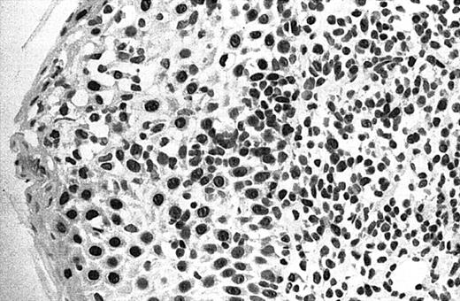 Fig. 2. Illustration of IHC staining of JUNB in an SS patient (case 8). / This photograph (original magnification × 40) revealed strong nuclear expression of JUNB by large epidermotropic tumor cells with absent expression in small dermal mononuclear cells. Epidermal basal keratinocytes also expressed JUNB, representing a useful internal control.