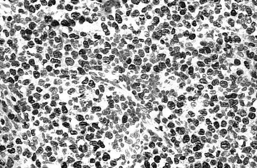 Fig. 3. Illustration of IHC staining of JUNB in a C-ALCL patient (case 38). / This photograph (original magnification × 40) showed strong nuclear expression of JUNB by large anaplastic cells with no expression by small reactive lymphocytes.