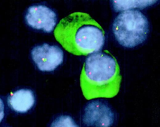 Fig. 1. Detection of t(14q32) by double-color FISH and Ig-light-chain staining in interphase plasma cells. / Cytospin slides from BM samples were fixed in 10% acetic acid solution in ethanol, followed by dehydration, denaturation (70% formamide), and dehydration. After hybridization of the probes overnight at 37°C, immunoglobulins were stained using FITC-conjugated goat anti-human light-chain antibodies to positively identify plasma cells. The IgH2 and C-α probes were detected following standard avidine-FITC and CY3 staining. The slides were mounted with antifade medium containing DAPI. Fusion signals of the probes indicate nontranslocated IgH loci, whereas split signals reflect a translocation of the IgH locus.
