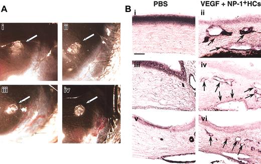 Fig. 5. Hematopoietic cells expressing NP-1 induce angiogenesis in corneal neovascularization assay. / (A) Gross appearance of neovascularization in the cornea. Pellets containing control buffer (i) or a low-dose VEGF (20 ng/mL) with CD45+NP-1− hematopoietic cells (ii) did not induce corneal neovascularization; on the other hand, pellets containing a low-dose VEGF with CD45+NP-1+hematopoietic cells (iii) or high-dose VEGF (100 ng/mL) (iv) induced corneal neovascularization. (B) Histologic analysis in mouse cornea. Sections were stained with anti–PECAM-1 (i-ii), anti–VEGFR-2 (iii-iv), or anti–VE-cadherin (v-vi) antibody, and positive cells are visualized as dark blue products. Pellets containing a low dose of VEGF and CD45+ cells (ii,iv,vi) induced the blood vessel formation composing with PECAM-1+ (ii), VEGFR-2+ (iv), or VE-cadherin+ (vi) ECs into cornea; however, pellets containing PBS alone did not (i,iii,v). Arrows indicate newly formed vessels into cornea. Scale bar indicates 50 μm.