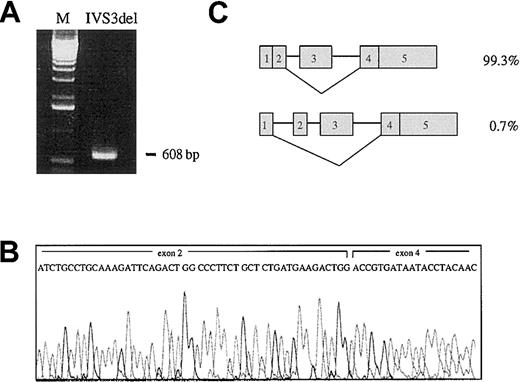 Fig. 3. Analysis of the IVS3+1_+4delGTAA mutation in transfected COS-7 cells. / (A) Electrophoresis profile of the uncloned RT-PCR product. M denotes the 1-kb ladder DNA size marker. (B) Sequence of the uncloned RT-PCR product. The IVS3+1_+4delGTAA mutation leads to exon 3 skipping. (C) Cloning of the RT-PCR reaction shows that this product accounts for more than 99% of the aberrant transcripts (148 of 149 clones); fewer than 1% of clones (1 of 149) showed exon 2 and exon 3 skipping.