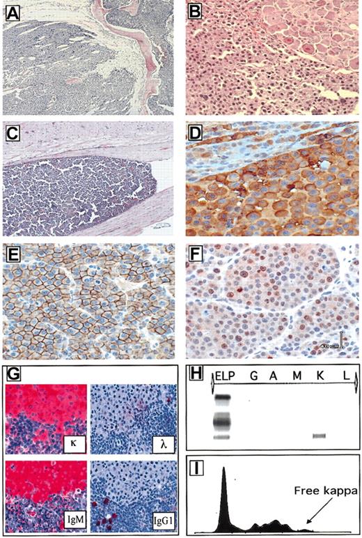 Fig. 6. Plasma cell immunophenotype and clonality. / Plasma cell involving the bone marrow replaced the normal bone marrow and disrupted the bone trabeculae (A, × 200). Neoplastic plasma cells often infiltrated the perispinal tissues and ganglions (B, × 200) and in some cases invaded the central nervous system (C, × 200). NPM-ALK was largely confined within the cytoplasm of the neoplastic plasma cells (D, × 400). Tumor cells were invariably CD138+ (E, × 400), displayed a variable number of Ki-67+ cells (F, × 400) and they expressed clonotype heavy and light immunoglobulin determinants (G, × 100). The serum analysis also demonstrated the presence of free light chain immunoglobulin (H-I).