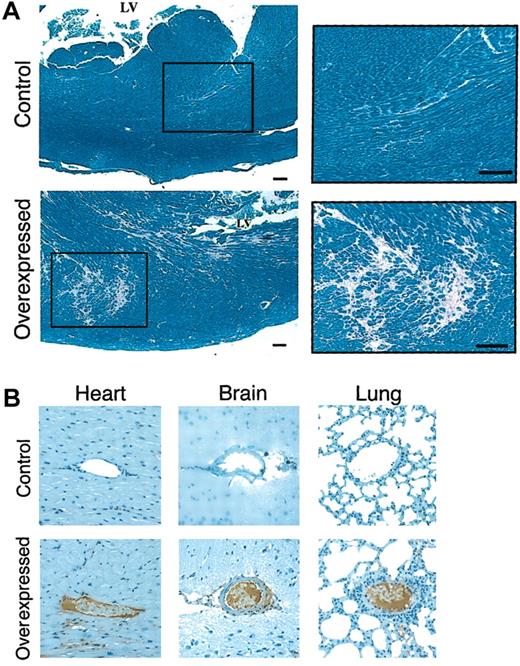 Fig. 2. Histochemical analysis of animals. / (A) Histochemical analysis of myocardium in mice expressing low and high levels of hFIX. Tissue samples were stained with PTAH.14 Control indicates the normal left ventricle in a mouse expressing low levels of hFIX. Area surrounded by a rectangle is enlarged for higher magnification in the right panel. Overexpressed indicates the corresponding left ventricle with multifocal myocardial fibrosis in a mouse expressing high levels of hFIX. Area surrounded by a rectangle is enlarged for higher magnification in the right panel. Scale bars represent 100 μm. (B) Immunohistolochemical analyses of tissues from animals expressing low and high levels of hFIX. Tissue samples were stained with fibrin-specific monoclonal antibody.15 Heart indicates fibrin-stained normal myocardial vessel of control mouse, and fibrin depositions on endothelium of a vessel in a high hFIX–expressing mouse. Brain indicates normal vessel of control mouse, and abnormal vessel occluded by thrombus of high hFIX–expressing mouse. Lung indicates normal vessel of control mouse, and fibrin-positive thrombotic material–filled abnormal vessel. Original magnification, × 200.