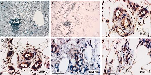 Fig. 7. Localization of MMPs in neovessels in a human recanalized mural thrombus. / Immunohistochemistry was performed on paraffin sections of a mural thrombus, as described in “Material and methods.” Fibrin(ogen) present in the thrombus was stained with a polyclonal antibody against fibrin(ogen) (A), and endothelial cells in newly formed vessels were stained with an anti–CD-31 antibody (B). The endothelial cells of the newly formed microvessels were stained for MMP-1 (C), MMP-2 (D), MMP-3 (E), and MT1-MMP (MMP-14) (F). Scale bars = 50 μm. Results are representative of the organized plaques of 2 patients. Arrows indicate areas of positive staining.
