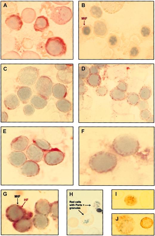 Fig. 1. Immunocytochemical studies on bone marrow and peripheral blood smears from healthy controls and patients with sideroblastic anemia. / (A) Immuno-alkaline phosphatase staining of bone marrow cells from a healthy control using the monoclonal antibody rH02 specific for the H subunit of ferritin shows strong diffuse positivity in the cytoplasm of some erythroblasts. (B) Immuno-alkaline phosphatase staining of bone marrow cells from the previous healthy control using a polyclonal antibody raised against the MtF. Most erythroblasts are negative; the erythroblast on the left (arrow) shows weak positivity. (C) Immuno-alkaline phosphatase staining of bone marrow cells from a patient with XLSA using the anti-HF monoclonal antibody shows diffuse cytoplasmic positivity in a few erythroblasts. (D) Immuno-alkaline phosphatase staining for MtF of bone marrow cells from the previous XLSA patient. Many erythroblasts are positive with granules ringing the nucleus. (E) Immuno-alkaline phosphatase staining for HF of bone marrow cells from a patient with RARS. Diffuse cytoplasmic positivity is present in some erythroblasts. (F) Immuno-alkaline phosphatase staining for MtF of bone marrow cells from the previous patient with RARS. Positivity with granules surrounding the nucleus is present in 2 erythroblasts. (G) Double immunocytochemical staining for HF (immuno-alkaline phosphatase reaction) and MtF (immuno-β–galactosidase reaction) on a bone marrow smear from a patient with XLSA. The cellular distributions of HF and MtF are quite different, HF being diffusely distributed in the cytoplasm (red staining) and MtF localized in perinuclear granules (turquoise staining). (H) Perls Prussian blue staining of a peripheral blood smear from a patient with RARS; positive granules are visible in 2 red cells. (I) Immuno-alkaline phosphatase staining for MtF of peripheral blood smear from a patient with RARS; unequivocal positivity is observable in a circulating red cell. (J) Immuno-alkaline phosphatase staining for MtF of bone marrow cells from a patient with XLSA; a positive erythroblast (on the left) and a positive red cell (on the right) are shown. Original magnification, × 1250.