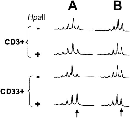 Fig. 2. Results of HUMARA-PCR in patient no. 10. / HUMARA-PCR (A) at the time of diagnosis (10-I) and (B) after induction of CCR by imatinib (10-R). HpaII indicatesHpaII-digested DNA. The arrow indicates the position of the larger allele. In this case, the 2 alleles differed only by 1 triplet.