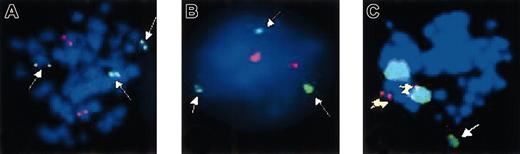 Fig. 4. FISH analysis of patient no. 35 after 11 months on imatinib. / (A) Metaphase and (B) interphase preparations were hybridized with anAML1-ETO translocation probe. The 3 green signals (white arrows) correspond to chromosome 21q22 and indicate a break in this region in one chromosome 21; the 2 red signals correspond to the normal chromosome 8p22. (C) Metaphases were hybridized with a chromosome 3 paint (large green signals) and a locus-specific probe corresponding to chromosome 21q22.13-q22.2 (small red signals). There is colocalization of both probes (yellow arrows). Note the additional green signal corresponding to the translocated part of chromosome 3 (white arrow).