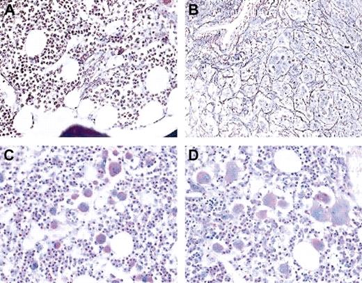Fig. 6. Bone marrow histology. / Bone marrow histology in patient no. 1 prior to imatinib (A,C) and after 6 months on imatinib (B,D). Upper panels are silver stain; lower panels are periodic acid-Schiff stain. Cytogenetic analysis showed 100% Ph+ prior to imatinib and 0% Ph+ at the time of the follow-up biopsy. Note the increase in reticulin fibers and the marked change in megakaryocyte morphology. Magnification × 20 in all panels.