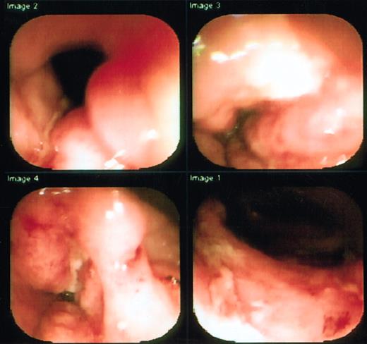 Fig. 1. Pretransplantation colonoscopy of first patient shows deep serpiginous ulcers in transverse colon. / The colonoscope was unable to transverse the inflammed and narrowed segment.
