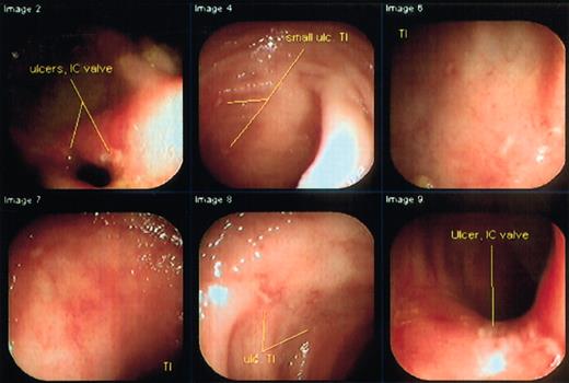 Fig. 2. Colonoscopy of the first patient shows marked improvement 6 months after transplantation. / Full colonoscopy was easily performed showing only a few superficial ulcerations in the area of the ileocecal valve.