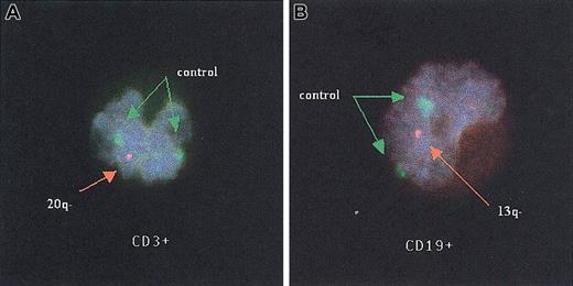 Fig. 2. Fluorescent in situ hybridization studies of T and B lymphocytes. / T (A) and B (B) lymphocytes from 2 patients with myelofibrosis with myeloid metaplasia that exhibit a single orange signal revealing a deletion of the long arm of either chromosomes 20 (20q−) or 13 (13q−), respectively, by fluorescent in situ hybridization studies. Both green signals of the control probe (CEP9) are visible in each figure. Original magnification, × 100.