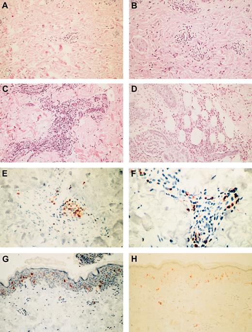 Fig. 1. Representative inflammatory responses to the allogeneic combination vaccine in punch biopsy specimens from the injection site. / (A) Mild perivascular lymphocytic inflammation in first sample (patient 13; hematoxylin and eosin (H&E) stain; original magnification, × 20). (B) Moderate perivascular lymphocytic and eosinophilic inflammation in first sample (patient 14; H&E stain; original magnification, × 20). (C) Severe perivascular lymphocytic inflammation in first sample (patient 4; H&E stain; original magnification, × 20). (D) Severe eosinophilic panniculitis in first sample (patient 14; H&E stain; original magnification, × 20). (E) Moderate infiltration of CD4+ lymphocytes in first sample (patient 1; CD45RO/OPD4 stain; original magnification, × 40). (F) Abundant perivascular CD8+ lymphocytes (patient 19; CD45RO/C8/144B stain; original magnification, × 40). (G) Retention of epidermal CD1a+ and rare dermal perivascular Langerhans cells (patient 20; O10 stain; original magnification, × 20). (H) Control tissue from healthy volunteer (O10 stain; original magnification, × 20).