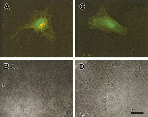 Fig. 2. Rescue in fucosylation of LADII fibroblasts by complementation with the full-length GDP-fucose transporter gene. / Skin fibroblasts obtained from the patient were transfected with a bicistronic vector containing a GFP reporter gene and the GDP-fucose transporter cDNA obtained from healthy (A-B) or LADII cells (C-D). Five days after transfection, LADII fibroblasts were stained with AAL to assess fucosylation (red). (A) Fibroblasts transfected (GFP-positive; green) with wild-type GDP-fucose transporter exhibit strong perinuclear staining, whereas (C) cells transfected with the ΔG588 transporter gene did not stain with AAL. The lower panels (B-D) show Nomarski optic images of the same fields as in panels A and C. Scale bar is approximately 50 μm.