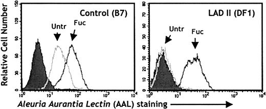 Fig. 3. In vitro restoration of fucosylated glycoconjugates after fucose supplementation of a LADII lymphoblastoid cell line derived from the patient. / Control (B7; left panel) or LADII-derived (DF1; right panel) EBV-transformed lymphoblastoid cells were kept in culture for 5 days in the presence (Fuc) or absence (Untr) of 10 mM L-fucose. Fucosylated glycoconjugates on the cell surfaces were detected with the AAL lectin. Filled histograms represent control samples in which staining was carried out in the presence of 100 mM L-fucose.