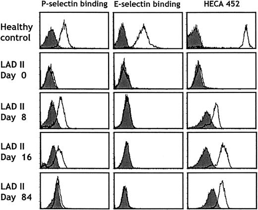 Fig. 5. Selectin binding and HECA 452 antigen expression on neutrophils before and during fucose therapy. / Neutrophils purified from a healthy donor (top panels) or the LADII patient (days 0-84) were analyzed for P- or E-selectin binding or HECA 452 antigen expression by flow cytometry using recombinant human P-selectin IgG or murine E-selectin IgM chimeras or the HECA 452 antibody. Filled histograms represent control stainings performed in the presence of 5 mM EDTA or rat IgG, respectively. Patterns similar to those on day 84 were obtained up to day 232 of treatment.