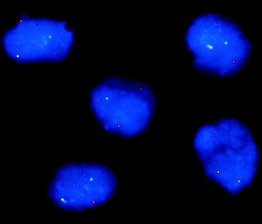 Fig. 2. FISH analysis of IL-7LN+ cells from patient no. 2 with a translocation t(9:11) and the respective MLL/AF9 gene fusion. / IL-7LN-transduced and sorted cells were hybridized with probes that flank the MLL breakpoint and were counterstained with DAPI. The MLL5′ probe is labeled with FITC (green signal) and the MLL3′ probe with CY3 (red signal). The colocalized signals define the normal allele, whereas the separated red and green signals represent the translocated allele.