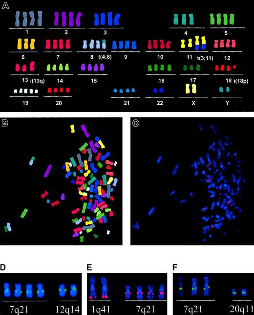 Fig. 3. Chromosomal mapping of proviral sequences by FISH. / FISH analysis using SF1m vector plasmid DNA as probe and subsequently performed M-FISH was established to detect proviral inserts in SF1m-transduced HT1080 cell line clones. (A-B) M-FISH karyogram and metaphase spread of HT1080 clone N3 presenting a near tetraploid karyotype (n = 87) with following recurrent chromosomal aberrations: dup(5p), t(4;8), t(3;11), i(13q), and i(18p). (C) Same metaphase spread after FISH using the SF1m vector plasmid DNA probe shows hybridization signals on the human wild-type MDR1 gene locus 7q21 and on chromosome 1q41. (D-F) Chromosomal localization of the SF1m vector plasmid DNA probe in HT1080 cell line clones N2 (12q14), N3 (1q41), and N4 (20q11), respectively. Additional signals are present on the human wild-type MDR1 gene locus (7q21).
