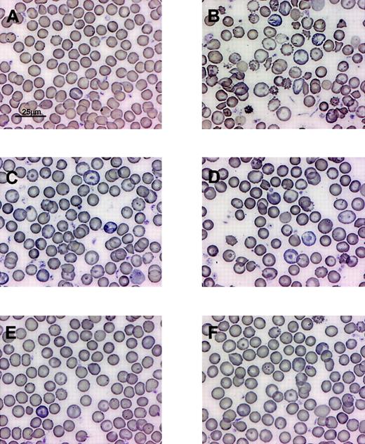 Fig. 6. The degree of correction of β-thalassemic red cell morphologic abnormalities correlates with the level of HbF resulting from lentiviral vector–encoded human γ-globin. / Wright-Giemsa–stained PB smears from (A) normal mouse, (B) mouse that received transplant of mock-transduced β-thalassemic BM cells, (C-F) mice that received transplants of γ-globin vector–transduced β-thalassemic BM cells and having HbF levels of 13%, 14%, 35%, and 16%.