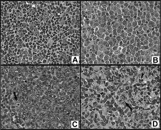 Fig. 1. Subtypes of grade 3 follicular lymphoma. / (A) Grade 3a contains more than 15 centroblasts/hpf in a background of centrocytes; (B) grade 3b consists of sheets of centroblasts with no admixed centrocytes; (C) grade 3bs consists predominantly of small centroblasts with no admixed centrocytes; a large centroblast (arrow) is shown for comparison; and (D) large cleaved cell lymphoma consisting of intermediate-sized to large cells with irregular, cleaved, or twisted nuclei, fine chromatin, and inconspicuous nucleoli; a large centroblast (arrow) and small centrocyte (arrowhead) are shown for comparison (H&E stains, original magnification, × 400).