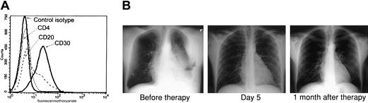 Fig. 1. AZT and IFN-α induce remission in a PEL patient. / (A) Primary tumor cells (BCLM) from an HHV-8+ PEL patient demonstrate typical phenotype of PEL. Surface expression of CD4, CD20, and CD30 on 1 × 106 cells from pleural fluid was determined by FACS analysis. (B) AZT and IFN-α induce remission in the PEL patient. Left: Chest x-ray of the same patient 2 days after diagnostic thoracentesis and before therapy with twice-daily parenteral AZT 1.5 g and IFN-α 5 million units. Middle: Chest x-ray 5 days after initiation of therapy. Right: Chest x-ray 1 month after therapy.