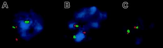 Fig. 2. Two-color FISH to interphase nuclei isolated from paraffin-embedded tissue for the detection of the MALT1translocation. / The orange PAC 117B5 (centromeric to MALT1) and green PAC 59N7 (telomeric to MALT1) show separate signals on interphases of a t(14;18)(q32;q21)+ hepatic MALT lymphoma, confirming MALT1 rearrangement (A). The same hybridization pattern is observed in a pulmonary t(11;18)(q21;q21)+ MALT lymphoma (B), whereas fusion signals are found in normal control nuclei (C).