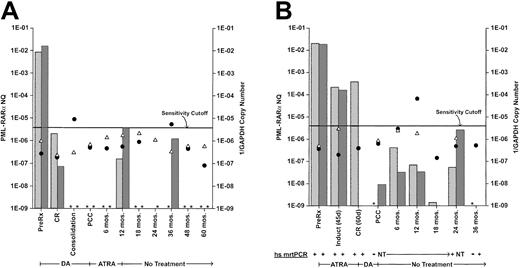 Fig. 4. Clinical course and serial monitoring of PML-RARα NQs derived from bone marrow and/or peripheral blood by real-time quantitative RT-PCR in 2 patients treated on protocol INT0129. / (A) Patient 1 received induction treatment with daunorubicin plus cytarabine (DA) and, after 2 courses of DA consolidation chemotherapy, received all-trans retinoic acid (ATRA) maintenance therapy for 1 year. (B) Patient 2 received remission induction treatment with ATRA and, after 2 courses of DA consolidation chemotherapy, received no further treatment. Both patients are in continuing clinical remission after longer than 5 years follow-up. The monitoring intervals designated on the abscissa are representational and not time-linear. PML-RARα NQs, indicated on the left ordinate, were determined by dividing PML-RARα copy number by GAPDH copy number. Bone marrow NQs, stippled columns; peripheral blood NQs, hatched columns. Assay sensitivity is represented by the reciprocal of the GAPDH copy number (1 divided by the GAPDH copy number), indicated on the right ordinate. The sensitivity cutoff at 1/2.5 × 105 GAPDH copies corresponds to a sensitivity detection level of 104.17 Thus, the further below the cutoff line, the more sensitive the assay, while values above the line were considered nonevaluable for use in cohort analyses, whether PML-RARα NQ− or NQ+, although the calculated PML-RARα NQs for positive samples are included in this chart. Reciprocal GAPDH values: bone marrow, closed circles; peripheral blood, open triangles. The presence of these symbols indicates that the sample was assayed; if the corresponding PML-RARα NQ column is absent and marked with an asterisk, it means that the sample was NQ−. Several bone marrow and peripheral blood samples for patient 2 were assayed by a high-sensitivity (hs) mrtPCR assay,17 as well as by real-time qrtPCR, and ± results are shown below the graph. NT, not tested.