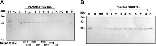 Fig. 1. Western blot and immunoprecipitation demonstrating significant levels of cCD20 in the plasma of patients with CLL. / (Panel A) Western blot showing detectable CD20 protein in plasma from patients with CLL. The plasma CD20 is similar in molecular weight to CD20 detected in cell lysates from BJAB cell line (BJ) and cells from a patient with CLL (C). As expected, no CD20 is detectable in lysate from the HL60 cell line (HL). Plasma from a healthy control individual (N) shows lower levels of CD20. Immunoprecipitation products from BJAB (B) and HL60 (H) cell lysates are also shown. Precipitation from beads and antibody without plasma or cell lysate is also shown as a negative control (NC). The molecular weight marker (M) is shown. One microliter of plasma is used in lanes that contain plasma. The levels of cCD20 detected in the plasma by ELISA are shown on the bottom. (Panel B) Coomassie blue-stained gel showing immunoprecipitation of CD20 from plasma of patients with CLL. The CD20 from cell lysates from BJAB (B) and CLL (C) are shown as positive control and from HL60 (H) as a negative control. Equal amounts of plasma (33 μL) from each sample were denatured before immunoprecipitation (abbreviation as in Panel A).
