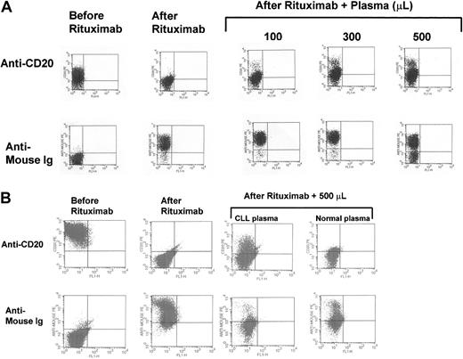 Fig. 8. Plasma cCD20 sequesters rituximab. / (A) Mixing study results demonstrating the capability of plasma cCD20 to compete for rituximab and prevent it from binding to CLL cells. The top row shows an analysis of CD20 on the surface of CLL cells before and after rituximab was added alone or along with plasma. The lower row shows detection of the rituximab on the surface of CLL cells using the PE-labeled anti-Fc fragment of the mouse Ig. (B) Mixing study results using Raji cells and plasma from a patient with CLL and plasma from a healthy control individual. There is greater inhibition of rituximab binding to the Raji cells using plasma from the CLL patient with high cCD20 compared with plasma from the healthy control individual.