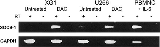 Fig. 2. Reactivation of SOCS-1 expression by DAC treatment in MM cell lines. / Cell lines XG1 and U266 were incubated with or without 1.0 μM DAC in complete medium for 96 hours. Peripheral blood mononuclear cells (PBMNCs) after stimulation with IL-6 for 2 hours served as positive control. The presence or absence of reverse transcriptase is indicated by RT+ or RT−, respectively. RT-PCR for GAPDH was performed for all samples to ensure the integrity of the reverse transcription reactions.